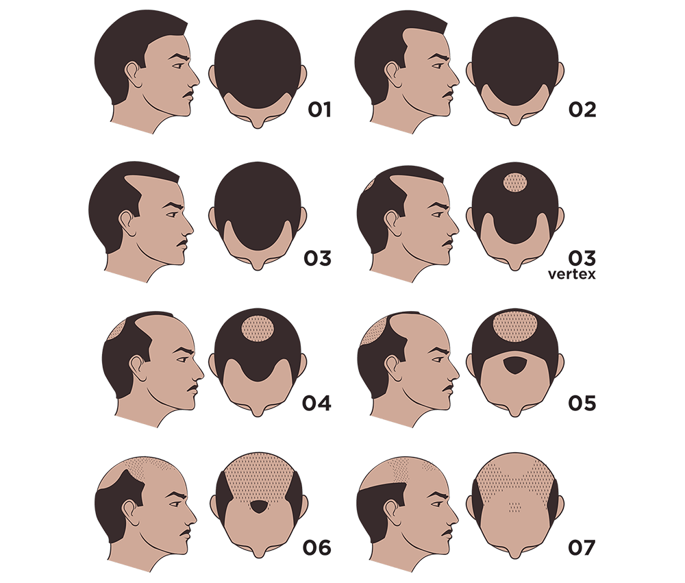Hair Loss, Hamilton-Norwood Scale