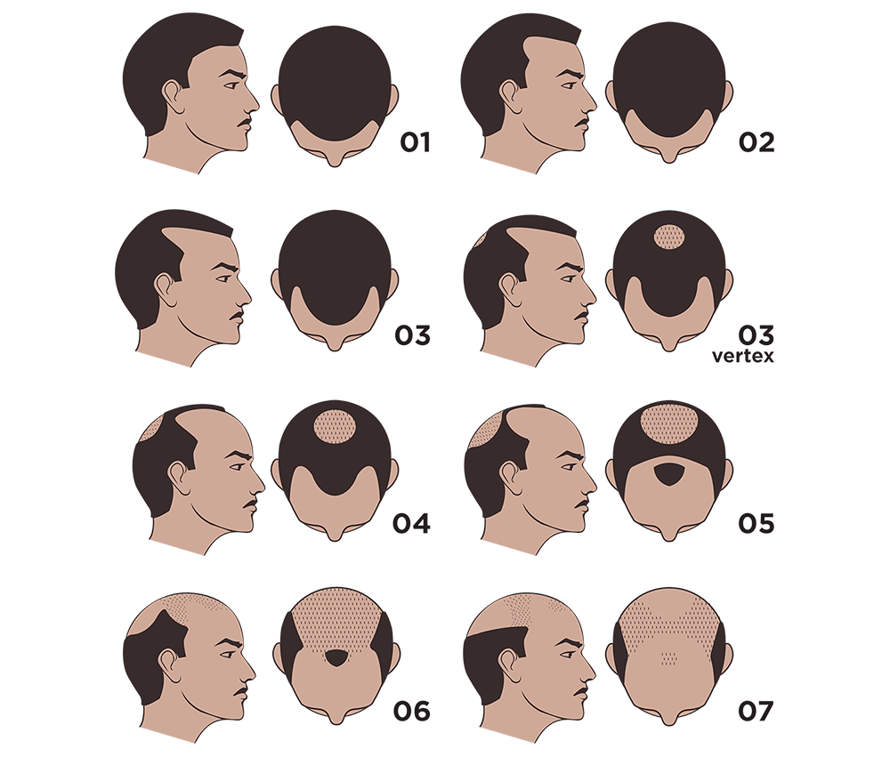 Hair Loss, Hamilton-Norwood Scale